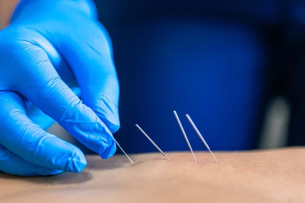 Unleash Better Health with Dry Needling from Alpha Sports!